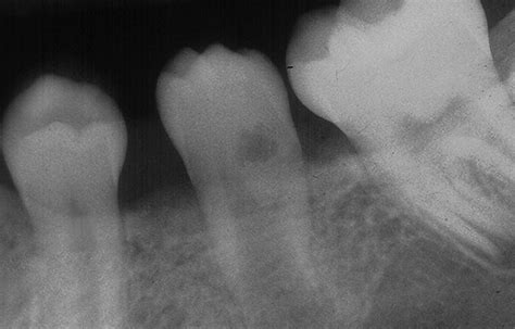 Case of the Week: Dens invaginatus with clinical photo – Dr. G's Toothpix