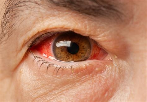 Red Eyes: Symptoms, Causes, and Treatments