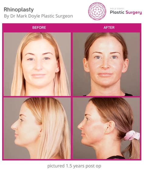 Rhinoplasty Recovery | goldcoastplasticsurgery.com.au