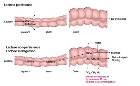 Update on lactose malabsorption and intolerance: pathogenesis ...