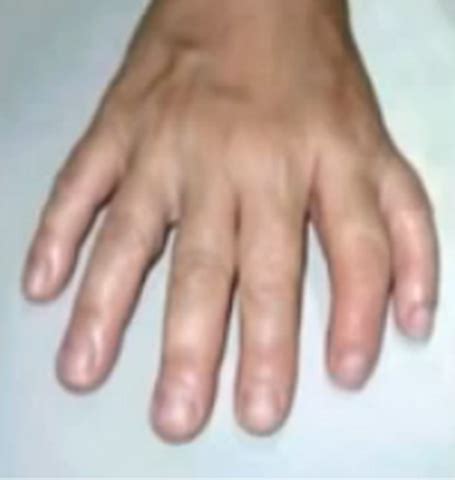 Patau Syndrome - Pictures, Symptoms, Causes, Treatment