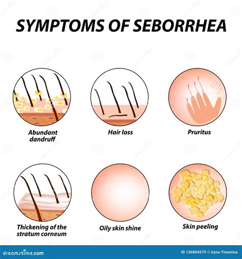 Symptoms of Seborrhea. Seborrhea Skin and Hair. Dandruff, Seborrheic Dermatitis Stock Vector ...