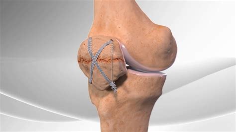 Patella Fracture Treatment - kawevqthreads