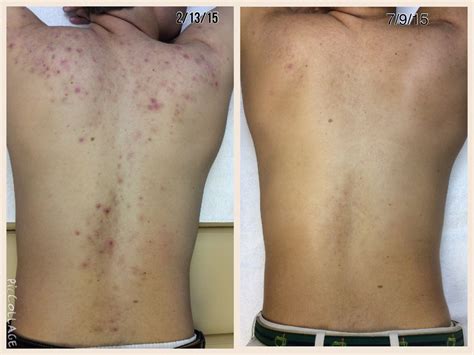 Yes! We can help with acne on the back and chest as well. Here are his results after 5 months ...