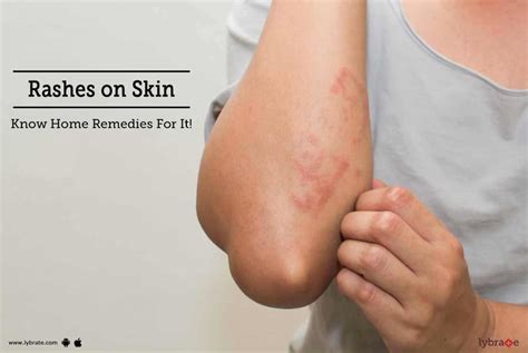 Rashes on Skin - Know Home Remedies For It! - By Dr. Ashwini Mohan | Lybrate