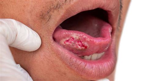 Oral Squamous Cell Carcinoma: Mouth Cancer Symptoms and More