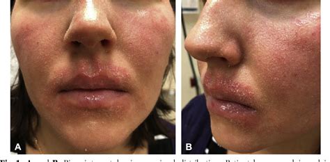 Figure 1 from Perioral Demodex folliculitis masquerading as perioral ...