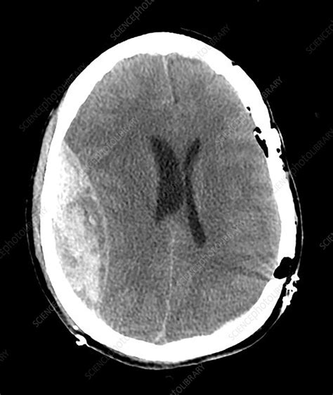 Large Epidural Hematoma CT - Stock Image - C043/2983 - Science Photo Library