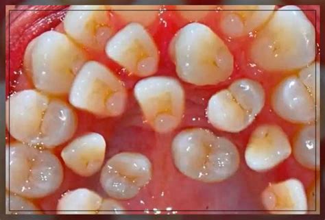 Hyperdontia Causes, Symptoms and Treatment - Dentist Ahmed