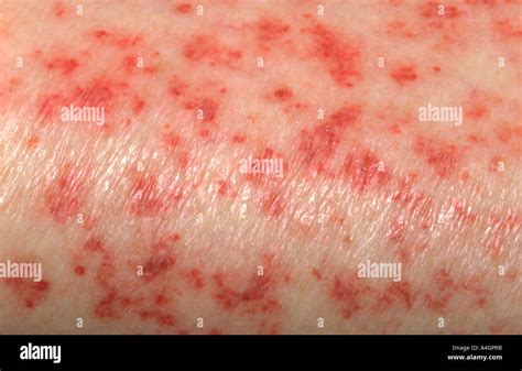 Anemia Skin Rash