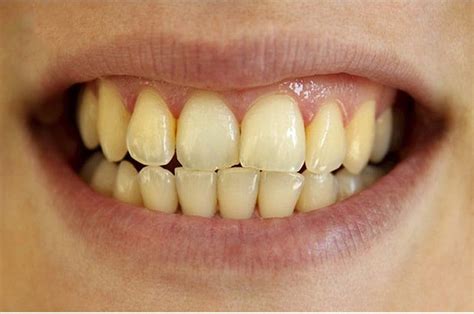 Yellow teeth: Causes and treatment | Vinmec