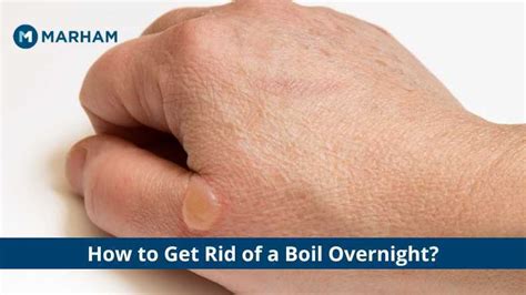 How to Get Rid of a Boil Overnight? - Home Remedies to Treat Boil | Marham