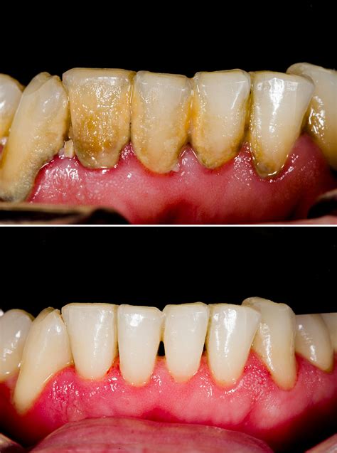 Periodontal Disease (Gum Disease) - Tuxedo Dental Group