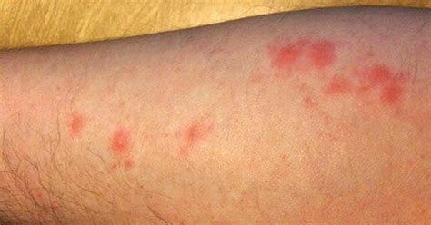 Bed Bug Bites Symptoms - The BedBug Exterminators