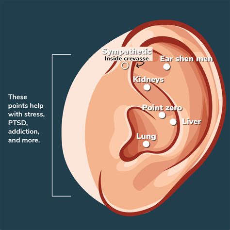 Acupuncture Ear Seed Demo | NADA Protocol - Aligned Modern Health