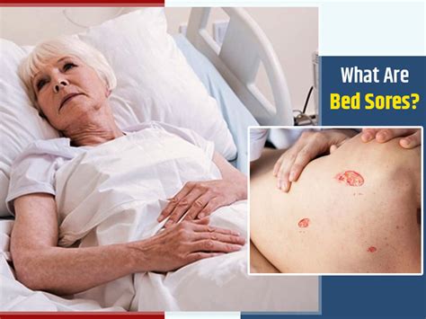 Bed Sores: Know Symptoms, Causes And Risk Factors For This Skin Condition | OnlyMyHealth