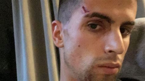 Cancelo Suffers Facial Injury During Burglary At His Home