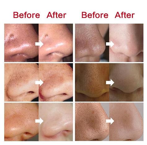 You may have no time for clogged pores or excess oil as like others but you may have a little ...