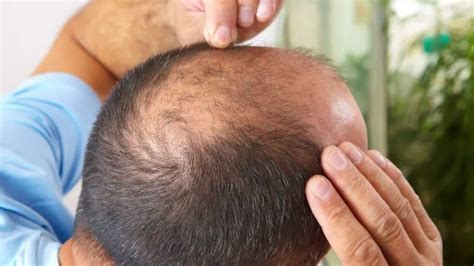 18+ bald spot haircut - KharisBaran