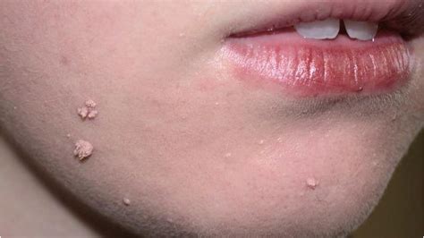 What Does Hpv On The Lips Look Like - Infoupdate Wallpaper Images