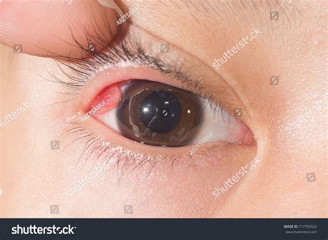 Close Pyogenic Granuloma During Eye Examination 스톡 사진 717750322 | Shutterstock