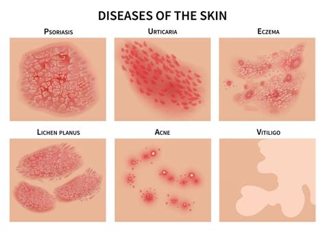 Eczema – Dr Keshav's