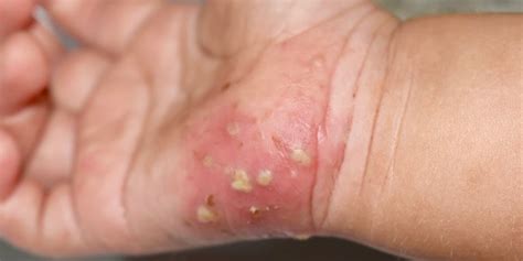 Scabies in Babies: Symptoms, How It Spreads And Treatment