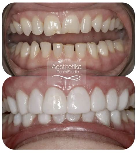 Composite Bonding Package Kingston | Cosmetic Dentist | Aesthetika