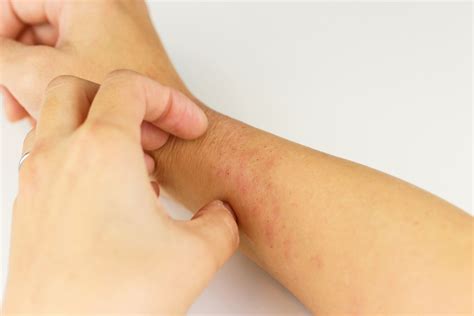 Pruritus therapies: What you’ve been itching to know | Dermatology ...