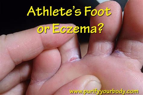 I thought I had athlete's foot - but it turned out to be eczema. Here ...