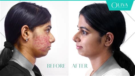 Laser Treatment For Acne Scars Cost In Bangalore - change comin