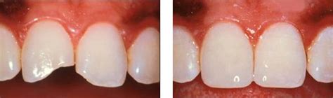 Composite Resin Restorations | Keri Shenker Dentistry