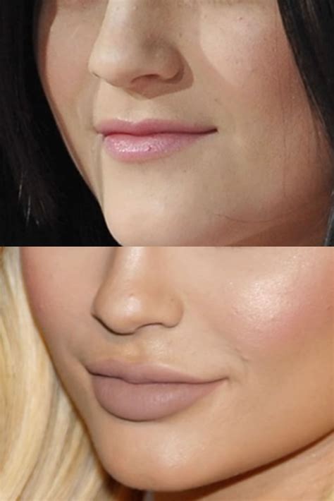 Celebrities Then And Now, Celebrities Before And After, Dermal Fillers, Lip Fillers, Lip ...