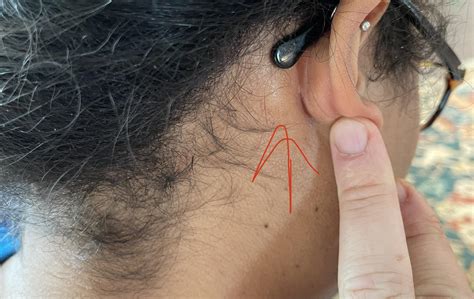 Hard lump behind both ears. : r/medical_advice