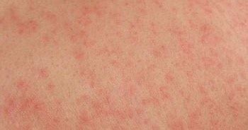 Skin Allergic Reaction | Health Food Nutrition