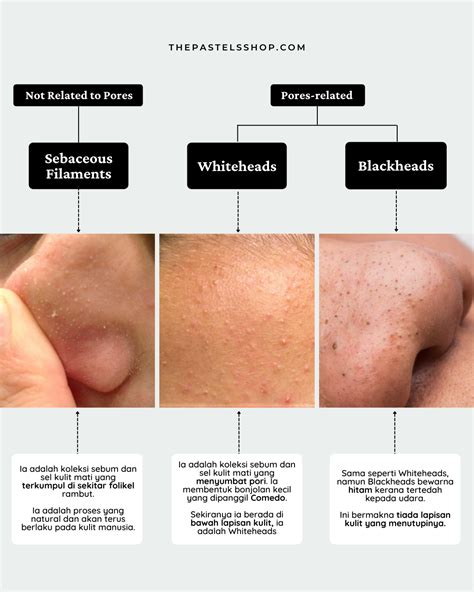 Sebaceous Filaments VS Whiteheads VS Blackheads – The Pastels Shop