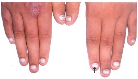 Causes Of Mees Lines : The Lines On Your Nails Mean A Lot For Your ...