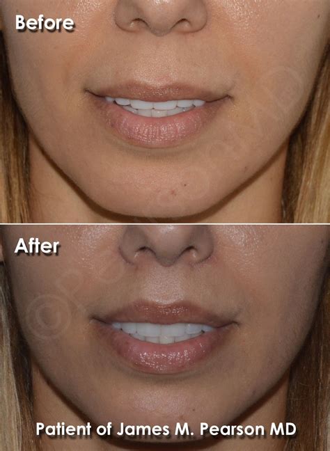 Photo Lip Lift Dr. James Pearson Facial Plastic Surgery in 2021 | Lip ...