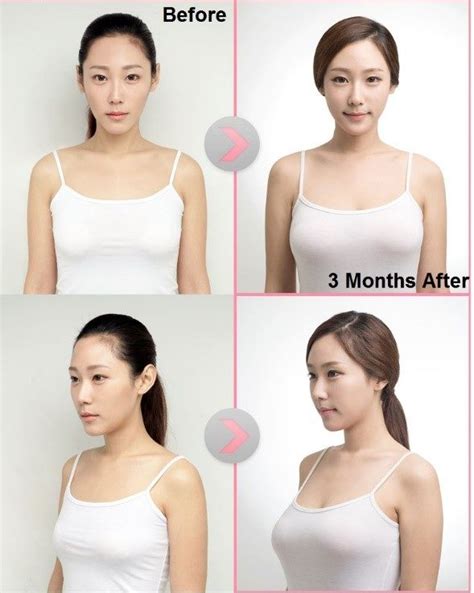 Your Guide To Breast Augmentation in Korea This 2022 - Seoul Guide Medical