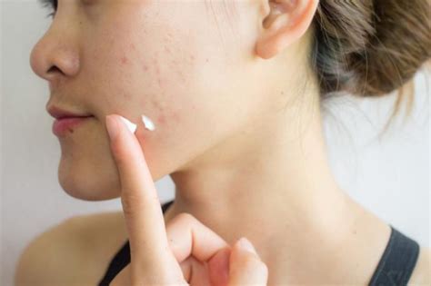 Boost Your Confidence With these Tried and Tested Acne Scar Removal Treatments | Techno FAQ