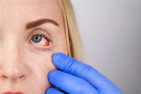 Uveitis - Symptoms, Causes & Treatment | Lions Eye Institute