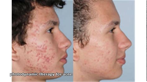 Photodynamic Therapy For Acne (PDT) Near Chicago Before, 45% OFF