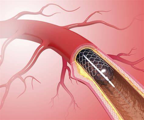 Anti-Platelet Drug Therapy After a Stent