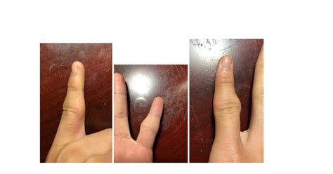 Will my untreated pinky finger cause problems in the future? : medical_advice