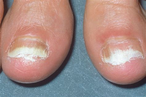 Nail Fungus: Causes, Symptoms, Treatments, And Prevention, 60% OFF