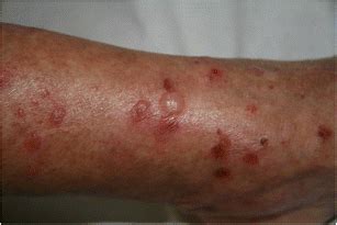 Bullous lupus erythematosus. Blistering lesions in an individual ...