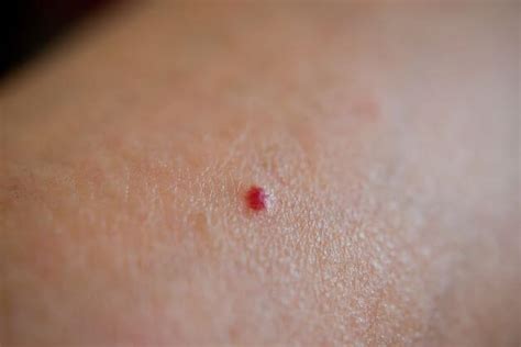 Cherry Angioma | Removal, Causes, Treatment, and Pictures