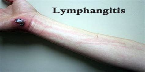 Lymphangitis - Assignment Point