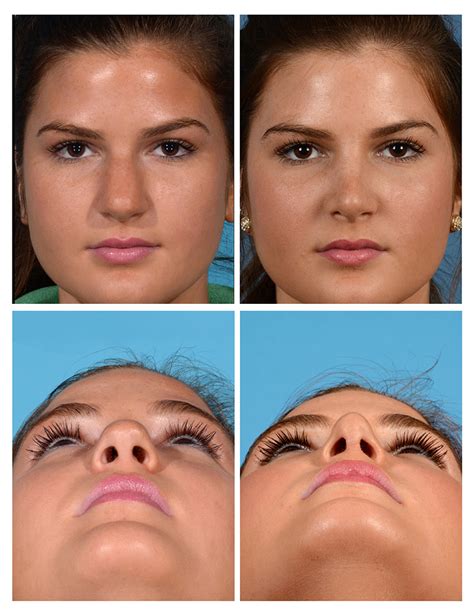Flared Nostrils Rhinoplasty Before And After - canvas-broseph
