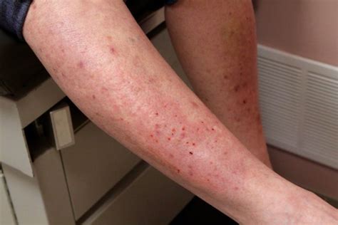 Celiac Disease Rash: Overview, Symptoms and Treatment - HealthPulls